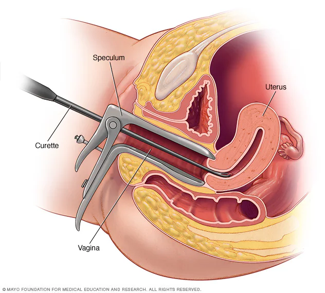 dilatation of cervix